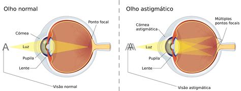 Astigmatismo (Astigmatism) .